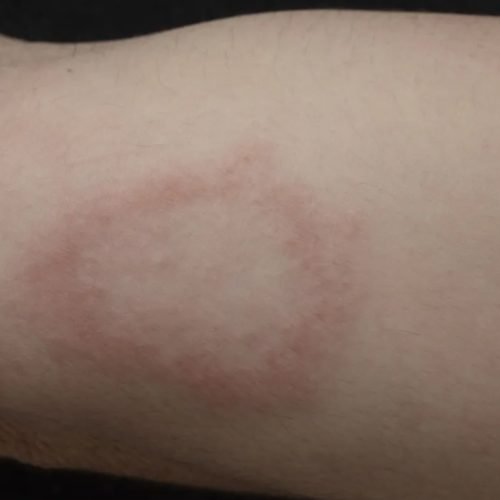 Foto: Ricardo Bhering/AI4Leprosy